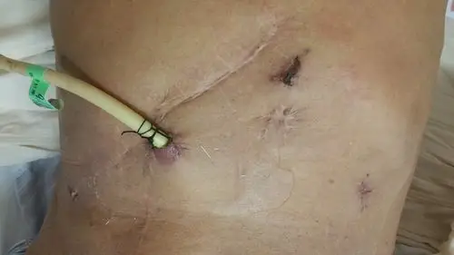 病历分享(一)两次开腹胆道手术后腔镜胆管切开取石