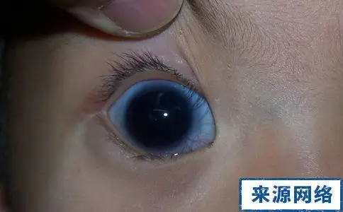 先天性青光眼症状图片