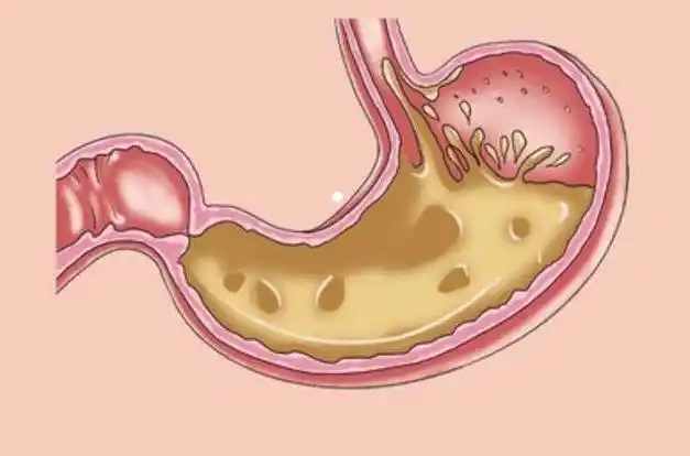 胃酸翻滚做到这5点让胃食管反流病远离你