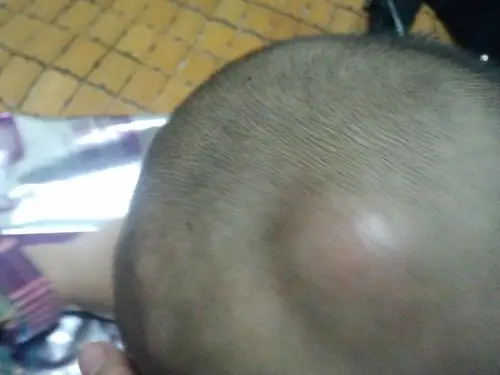 宝宝头部长了包怎么回事?