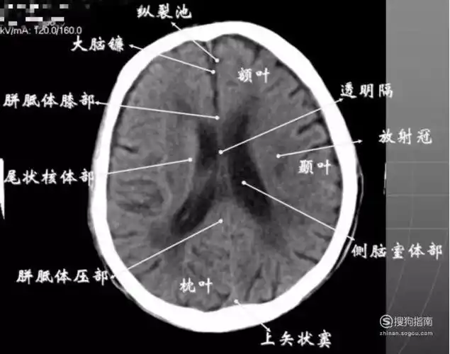 教你看头颅ct片