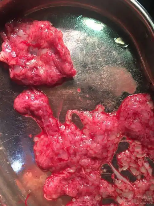 葡萄胎 - 妇产 -丁香园论坛