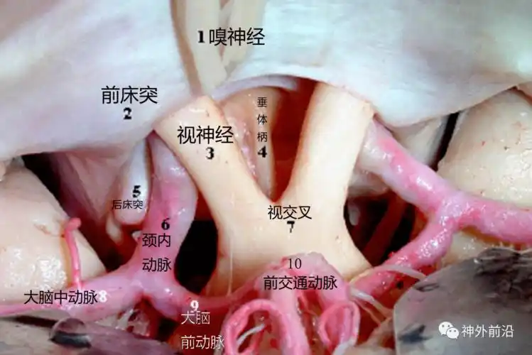图2-3-2垂体 1垂体前叶 2垂体柄 3垂体后叶