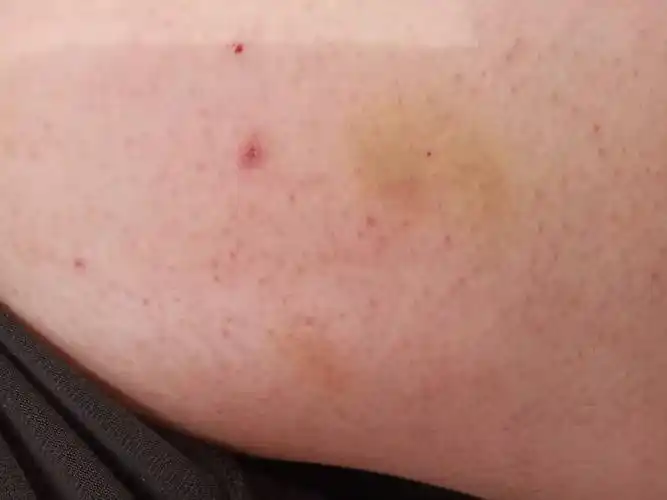 皮肤发黄怎么回事