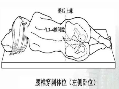 腰椎穿刺术过程中需要谨记的穿刺部位