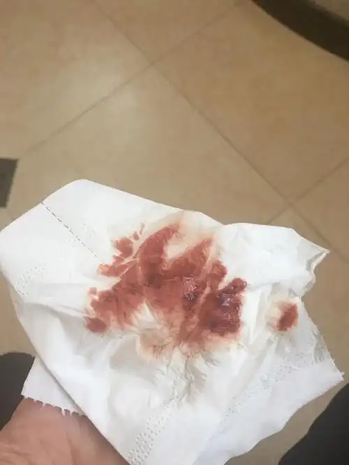 怀孕了为什么还会梦到流血(怀孕的时候梦到流血是为什么)