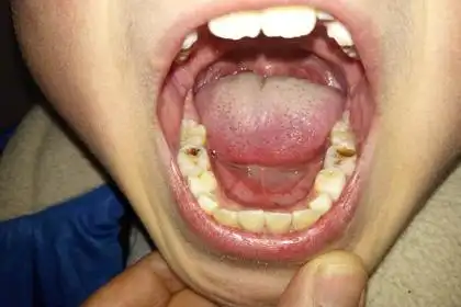 有一个10岁儿童下颌磨牙有龋齿,孩子父母竟然是首先关心是不是六龄齿