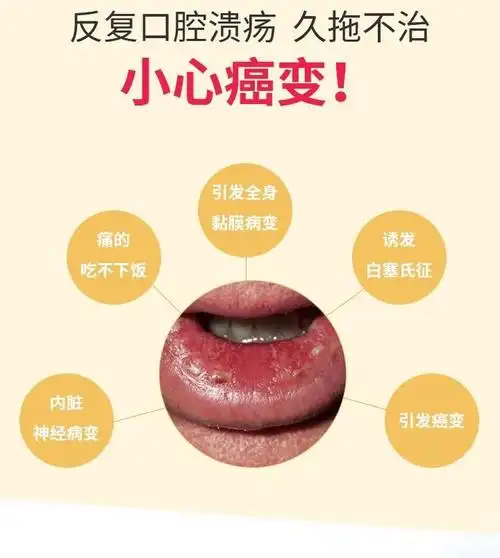 勿把舌癌当口腔溃疡