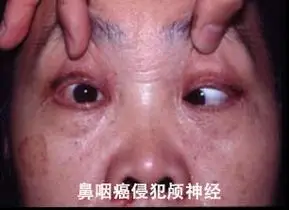 鼻咽癌的表现_鼻咽癌_症状_症状表现 - 好大夫在线