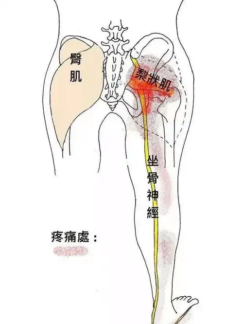 孕期的你坐骨神经痛真正的原因是