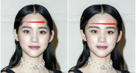 其实有很多人觉得自己额头可能太窄或太短,正面显得不_圈子-新氧美容