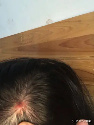 头皮结痂反反复复怎么办 - 知乎