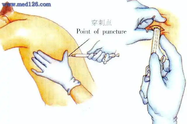 也可用套管针穿刺置管.