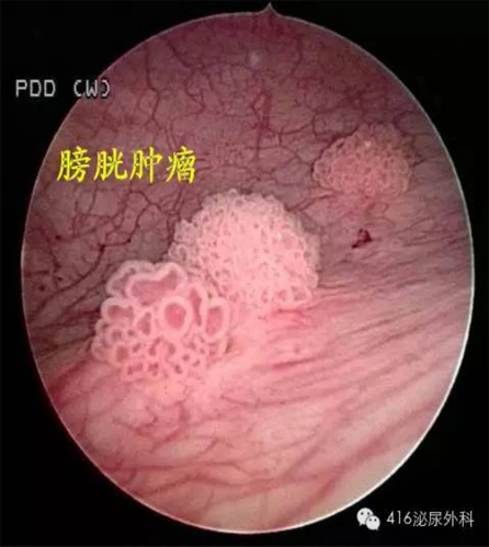 血尿泌尿系肿瘤的警报