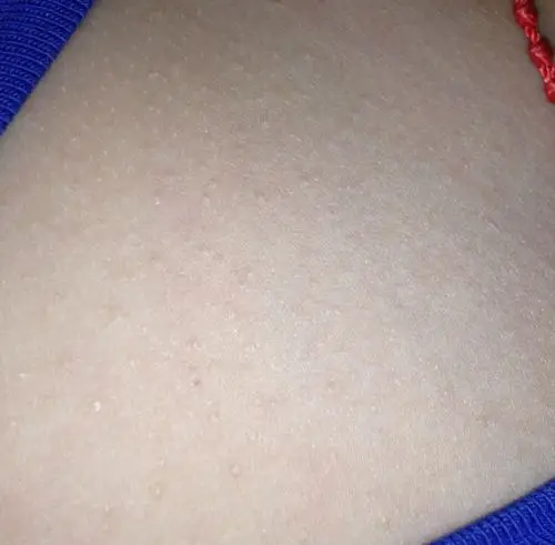 宝宝四岁,身上起了很多像痱子又像鸡皮疙瘩的点点,摸着赖手,不红,有时