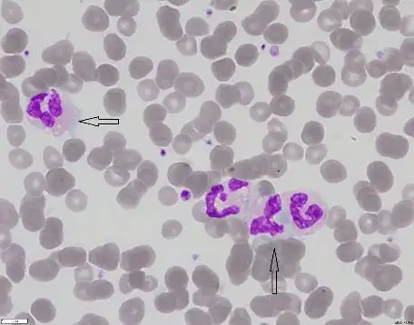 白细胞异常散点图背后的真相
