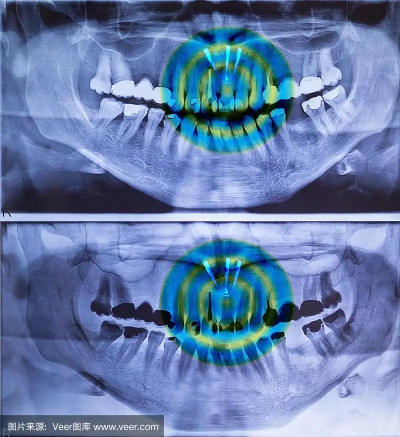 2个版本的牙科全景x光片及前牙疼痛影像
