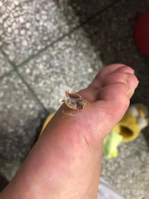 鸡眼怎么彻底挖出? - 知乎