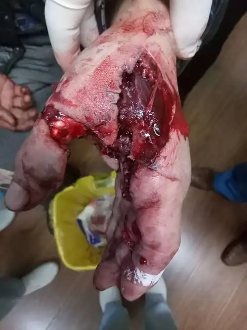 右手爆炸伤,虎口皮肤缺损.前臂带蒂皮瓣修复,重建虎口.