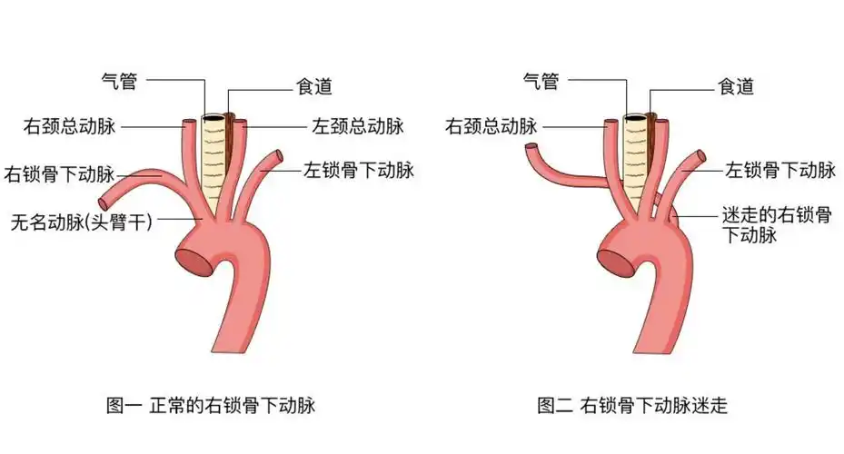 胎儿右锁骨下动脉迷走怎么办?