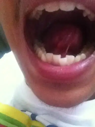 舌头长了小肉条状这个碰上疼是怎么回事?该怎么办?