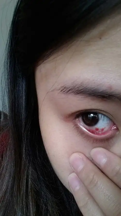 孕妇眼睛会充血吗?