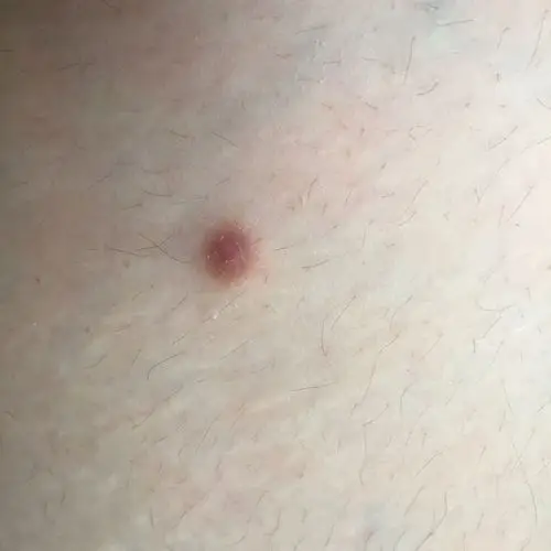 大腿外侧有硬疙瘩 左腿右腿都各有一个 好几年了 不痛不痒 什么情况?