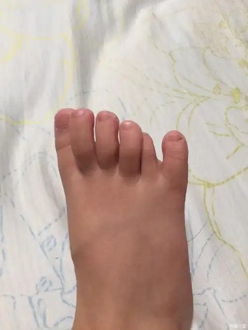 【图】宝宝右脚六趾,要不要动手术啊._上海论坛_汽车之家论坛