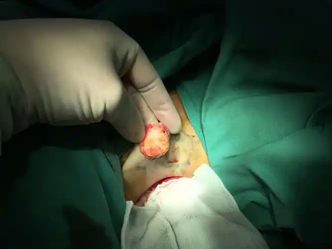 腋臭手术视频请关注微博,腋臭科王惠春_微信号