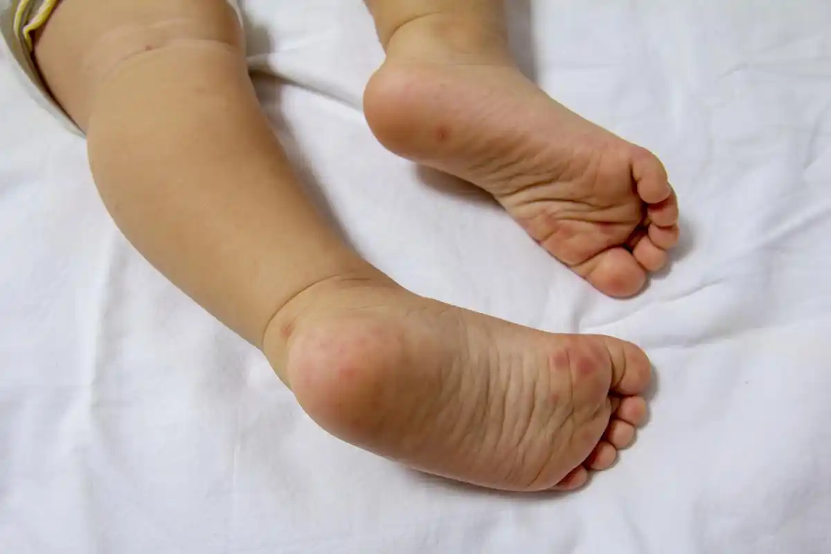 72155-8月是儿童手足口病流行高峰,这些症状要注意!