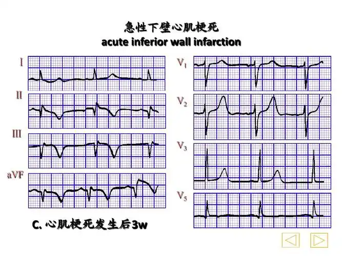 心肌梗死发生后3w