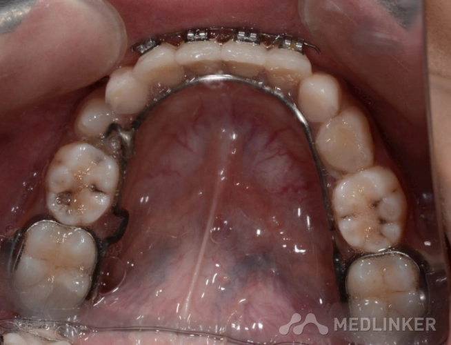 阻萌器抑制第一前磨牙萌出