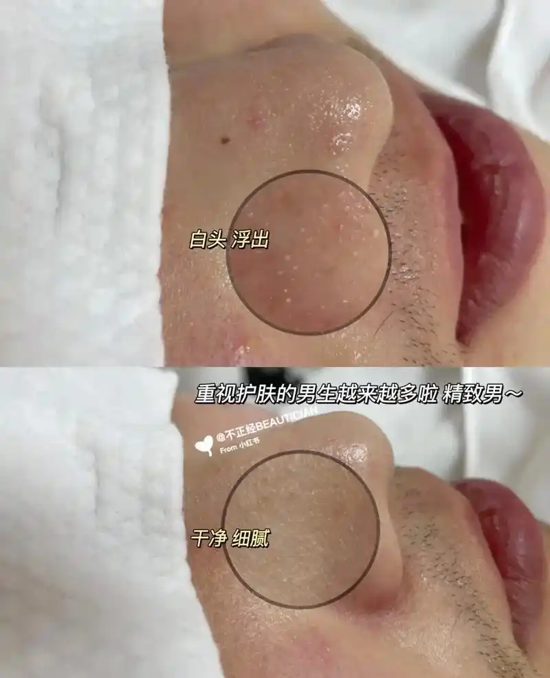 黑头粉刺看过来!毛孔堵塞了,闭口,黑头,粉剌,痘痘,毛孔粗大 - 抖音