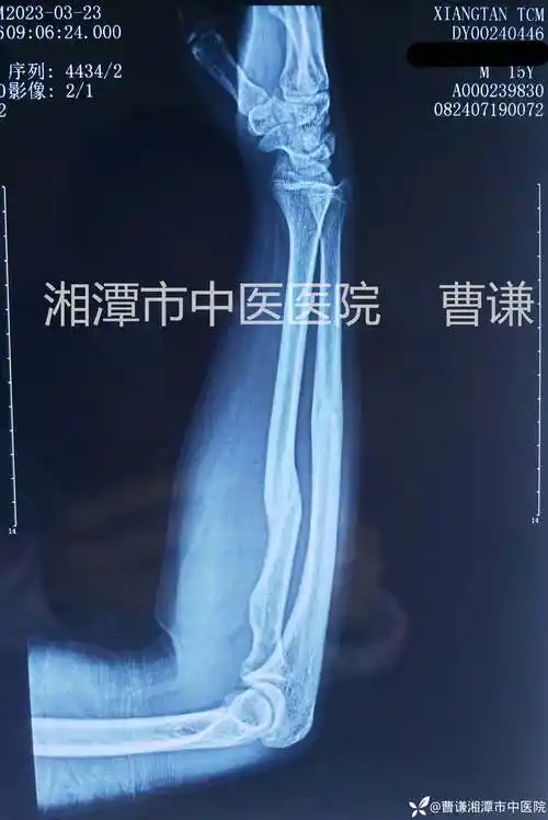 移位的尺桡骨中段双骨折并不需要按关节内骨折来处理