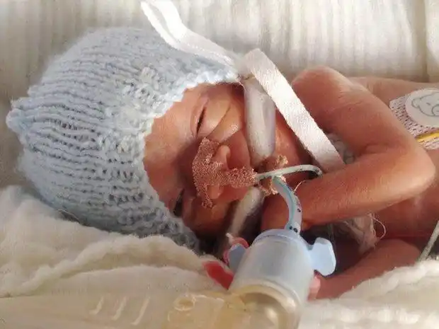 26周早产儿出生时不到1斤,被告知很难存活如今已经4岁