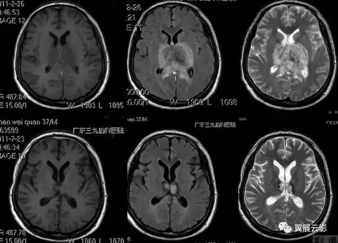 基底节区及丘脑对称性病变mri诊断