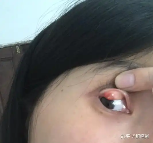 霰粒肿?肉芽肿? - 知乎