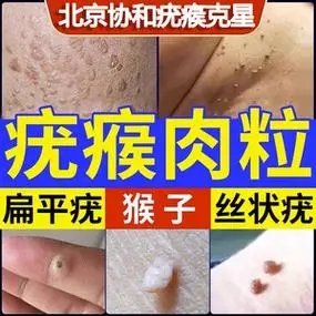 去疣药膏去脖子上长小肉粒除丝状扁平疣瘊子祛猴子疙瘩尤瘊克疣膏