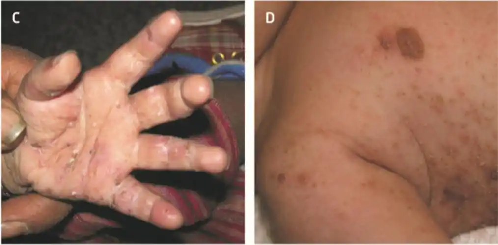 2020版疥疮国际诊断标准_疥疮_发病原因_症状表现 - 好大夫在线