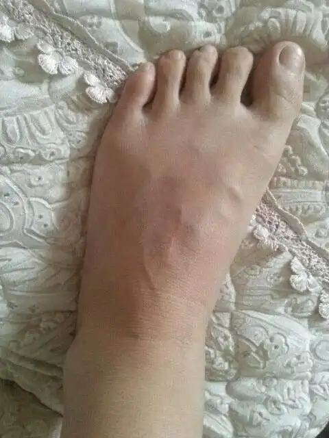 我脚背上的腱鞘囊肿动了手术才二个月又长了该怎么办,还压血脚神经,一