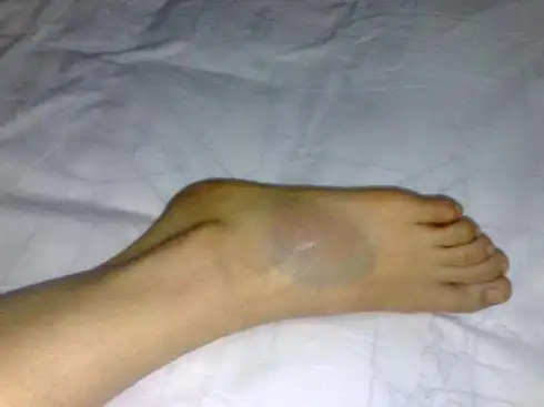 但如果是非常疼并且脚踝出现了红肿的时候,也只是简单的拿毛巾热敷一