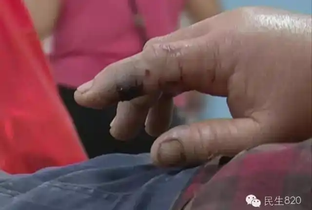 梅州女子做饭时突然被剧毒竹叶青咬中