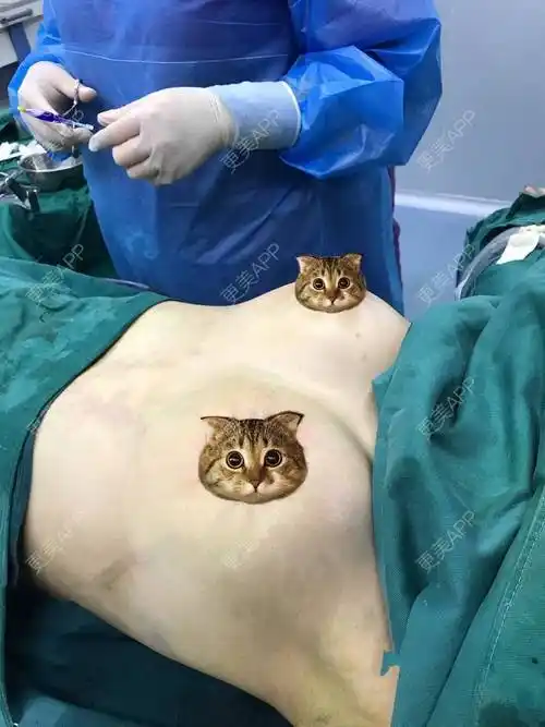 小马儿跑的胸部下垂矫正日记