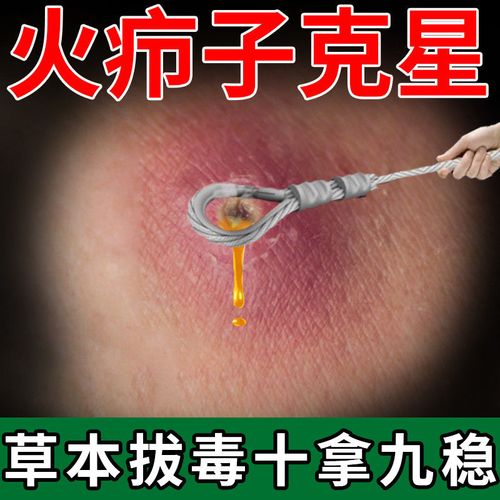 皮脂腺囊肿皮下脓包痘痘拔毒贴祛除粉瘤火疖子神器皮脂腺堵塞药膏