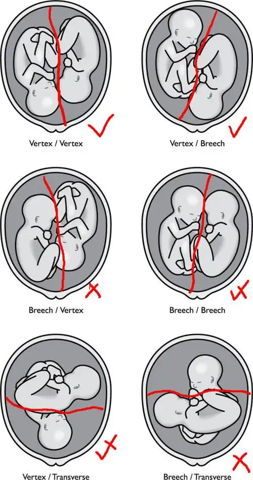 情况 第一个宝宝顺利分娩了 第二个宝宝转成了我们不希望见到的胎位