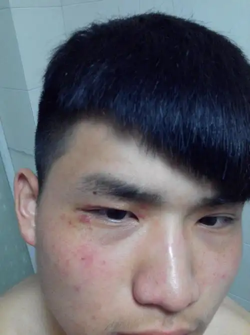 脸上突然长了好多红色的小点点,不痛不痒,本人18周岁,这是怎么回事