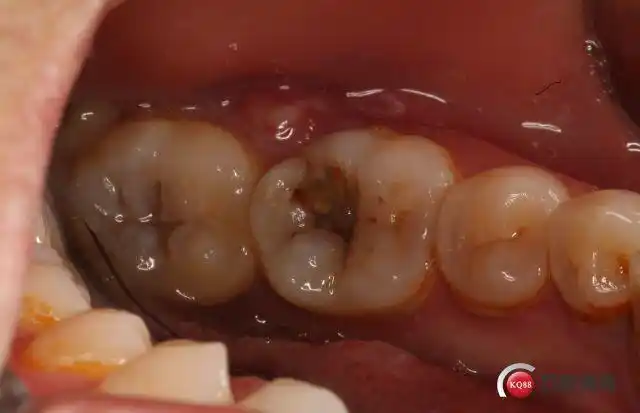 智齿冠周脓包近中引流一例