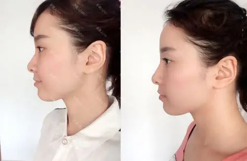 注射隆鼻 | 免费活动 | 微整形 | 国内整形 | 鼻部整形 | 玻尿酸