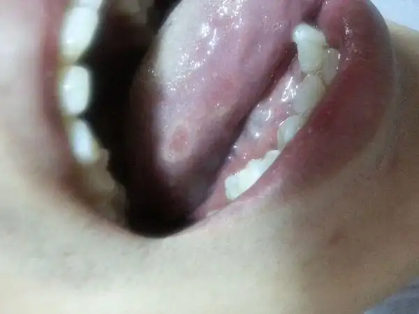 舌头边缘突然出现了一个白圈 这是怎么回事?