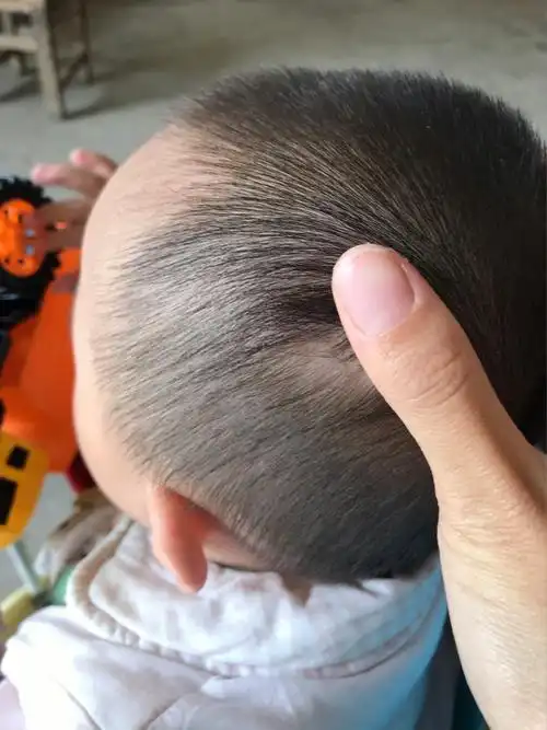 宝宝头摔了肿个包心疼死了